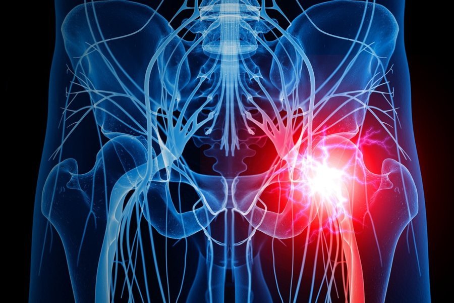 Sciatica